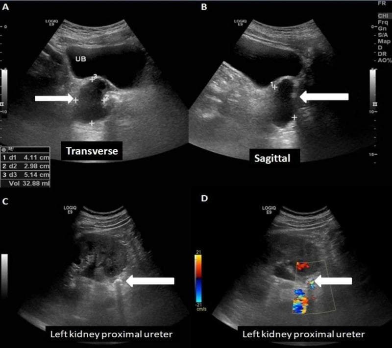 This diagnostic image composite features four ultrasound scans (A-D) demonstrating urological pathology. Panels A (transverse) and B (sagittal) show a well-defined cystic lesion (indicated by white arrows) measuring approximately 4.1 x 3.0 x 5.1 cm with a volume of 32.88 ml. The lesion displays internal echoes/debris and is located on the right posterolateral aspect of the urinary bladder (UB), causing extrinsic compression and indenting the bladder wall. Panels C and D focus on the left kidney and proximal ureter. Panel C reveals a hyperechoic structure within the proximal ureter, identified as an obstructing stone, characterized by strong posterior acoustic shadowing and associated upstream pelvicalyceal dilatation (hydronephrosis). Panel D utilizes color Doppler to highlight a distinct 'twinkling artifact' at the site of the ureteral stone, a characteristic finding for nephrolithiasis. This visual material is used in nephrology and radiology curricula to teach the sonographic identification of cystic pelvic lesions and obstructive uropathy secondary to ureteric calculi.
