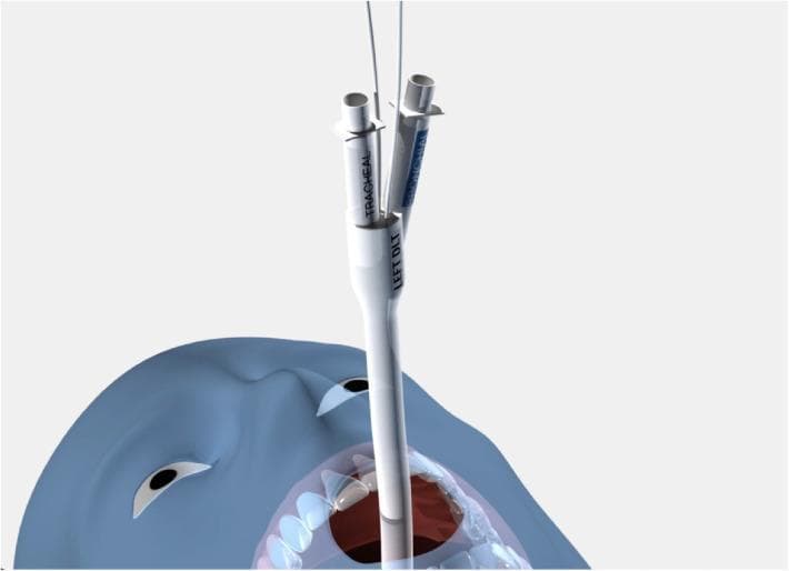 This medical illustration depicts a novel double-lumen endotracheal tube (DLT), specifically the sOLVe Tube, inserted into the oral cavity of a patient model. The device is shown in a left-sided orientation, indicated by the 'LEFT DLT' labeling on the proximal main shaft. The proximal end features a bifurcated design with two distinct ports for independent lung ventilation and access. One port is explicitly labeled 'TRACHEAL' and the other 'BRONCHIAL' (partially visible in blue), both ending in cylindrical metallic-finished connectors for anesthesia circuit attachment. Thin inflation lines for the tracheal and bronchial cuffs extend upward from the junction. The main tube body is constructed from light-colored, medical-grade silicone, designed for flexibility and to accommodate large-diameter bronchoscopes. This visual demonstrates the clinical placement of a universal DLT design intended for one-lung ventilation (OLV) and lung isolation in surgical or intensive care settings.