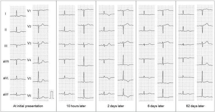 This Comparison Chart displays serial 12-lead electrocardiograms (ECGs) from a patient with non-ST-elevation myocardial infarction (NSTEMI), tracking progress from initial presentation through 10 hours, 2 days, 6 days, and 62 days later. The initial ECG shows mild ST-segment depression in the inferior leads (II, III, aVF) and precordial leads V2-V4, with upright T waves in the lateral leads (I, aVL, V4-V6). By 2 to 6 days follow-up, the ECG demonstrates characteristic dynamic evolution with the development of deep, symmetrical T-wave inversions in leads I, aVL, and V4-V6, suggestive of reperfusion or evolving ischemia in the anterolateral wall. The final follow-up at 62 days shows significant resolution of these changes, with ST segments returning to baseline (isoelectric) and T waves returning to an upright morphology. This serial progression illustrates the temporal electrical remodeling of the myocardium following a subendocardial ischemic event.