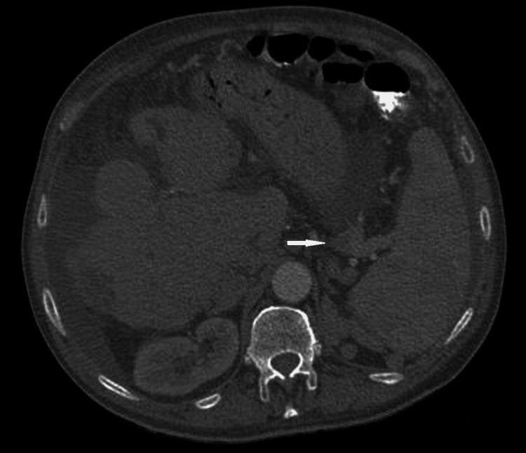 This diagnostic image is an axial cross-section of an abdominal CT scan showing the upper abdominal anatomy. In the posterior midline, the vertebral body and neural canal are clearly visible. Immediately anterior to the spine is the hyperdense abdominal aorta. To the left of the midline (patient's right), the liver appears enlarged with a somewhat heterogeneous texture. On the patient's left side, the spleen is visible. A white arrow points to the splenic hilum, highlighting multiple dilated, tortuous vascular structures characteristic of varices. These collateral vessels suggest portal hypertension or splenic vein pathology. Within the peritoneal cavity, low-density fluid is visible surrounding the liver and spleen, consistent with ascites. The stomach is visible anteriorly, containing mixed density material and gas. The image serves as an educational example of secondary signs of portal hypertension and the identification of perisplenic varicosities using contrast-enhanced computerized tomography.