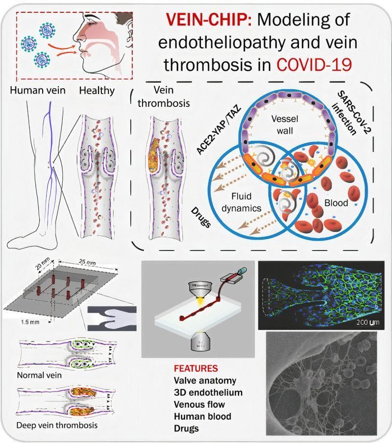 This medical infographic describes a 'Vein-Chip' microphysiological system designed to model endotheliopathy and venous thrombosis in the context of COVID-19. The visual is divided into several sections: an anatomical illustration showing SARS-CoV-2 entry via the respiratory tract, leading to vascular effects in the lower limbs; a comparative diagram of a 'Healthy' human vein versus one with 'Vein thrombosis,' highlighting the obstruction of the vessel lumen and valve architecture by a thrombotic mass; and a Venn diagram illustrating the interplay between ACE2-YAP/TAZ signaling, fluid dynamics, and blood components in vessel wall pathology. Technical diagrams detail the organ-on-a-chip engineering, including a 3D microfluidic device (25mm x 20mm) with specific valve geometry. The bottom right features high-resolution diagnostic imagery: a fluorescence micrograph (200 µm scale) showing endothelial cell junctions (green) and nuclei (blue) within the microvessel, and a scanning electron micrograph (SEM) providing a detailed view of the 3D endothelium and blood cell interactions. This educational resource is intended for advanced biomedical research and hematology studies, focusing on the pathophysiology of Deep Vein Thrombosis (DVT) and viral-induced vascular injury.