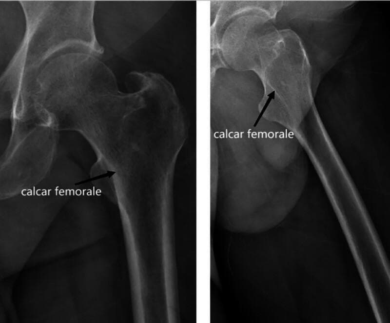 Two diagnostic X-ray radiographs show the proximal femur at different angles (Anteroposterior and likely a frog-leg or lateral view). Key visible landmarks include the femoral head, femoral neck, greater trochanter, lesser trochanter, and the proximal femoral shaft. The image highlights the calcar femorale with black arrows and text labels. Radiographically, the calcar femorale appears as a distinct vertical band of increased radiopacity (density) along the medial aspect of the femoral neck. It extends from the inferior femoral neck toward the lesser trochanter, demonstrating its role as a dense plate of cortical bone that provides structural support against compressive loads. The images illustrate the normal trabecular pattern and cortical thickness of the hip joint, emphasizing the biomechanical importance of the calcar in orthopedic surgery, particularly for fracture fixation and hip arthroplasty planning.