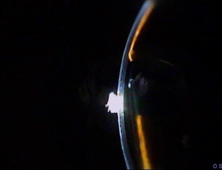 This clinical photograph, likely captured via slit-lamp biomicroscopy, provides a cross-sectional view of the anterior segment of the left eye (labeled OS). The image demonstrates a flat anterior chamber, a critical ophthalmic finding. The primary pathology is characterized by the total loss of depth in the anterior chamber, where the iris is in direct apposition with the posterior surface of the cornea. The cornea appears relatively clear with a visible light reflex on its surface, but its typical architecture is compromised by the lack of an aqueous-filled space between it and the iris. This clinical sign is highly significant in the context of ophthalmology, often associated with conditions such as narrow-angle glaucoma, penetrating ocular trauma, or post-surgical complications (e.g., wound leak or choroidal detachment). The educational focus is on the visual identification of a shallow or absent anterior chamber and understanding its implications for intraocular pressure and ocular health.