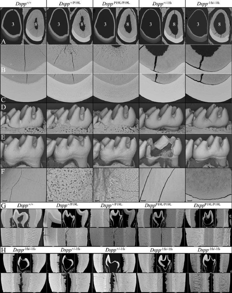 This composite diagnostic image displays backscattered scanning electron microscopy (bSEM) views of mouse tooth development, serving as a model for human dentinogenesis imperfecta and enamel defects related to DSPP (Dentin Sialophosphoprotein) mutations. The figure compares wild-type (Dspp+/+) specimens with various mutant genotypes: Dspp+/P19L, DsppP19L/P19L, Dspp+/-1fs, and Dspp-1fs/-1fs. (A) Cross-sections of 7-week-old mandibular incisors at levels 3 and 8 show a progressively thinner dentin layer and enlarged pulp chamber in mutant mice, most severe in the -1fs genotypes. (B, C) High-magnification views (400x) of incisor dentin and enamel; notable is the complete absence of dentinal tubules in the Dspp-1fs mice and more conspicuous enamel rod outlines in DsppP19L mice, indicating hypomineralization. (D, E) 3D surface reconstructions of D14 and 7-week molars demonstrate normal initial morphology but subsequent accelerated attrition, enamel surface roughness in DsppP19L, and catastrophic crown failures in Dspp-1fs mice. (F-H) Microscopic analysis of molar surfaces and cross-sections highlights uneven mineralization, loss of rod/interrod architecture in P19L mutants, and extremely thin dentin lacking tubules in -1fs mutants.