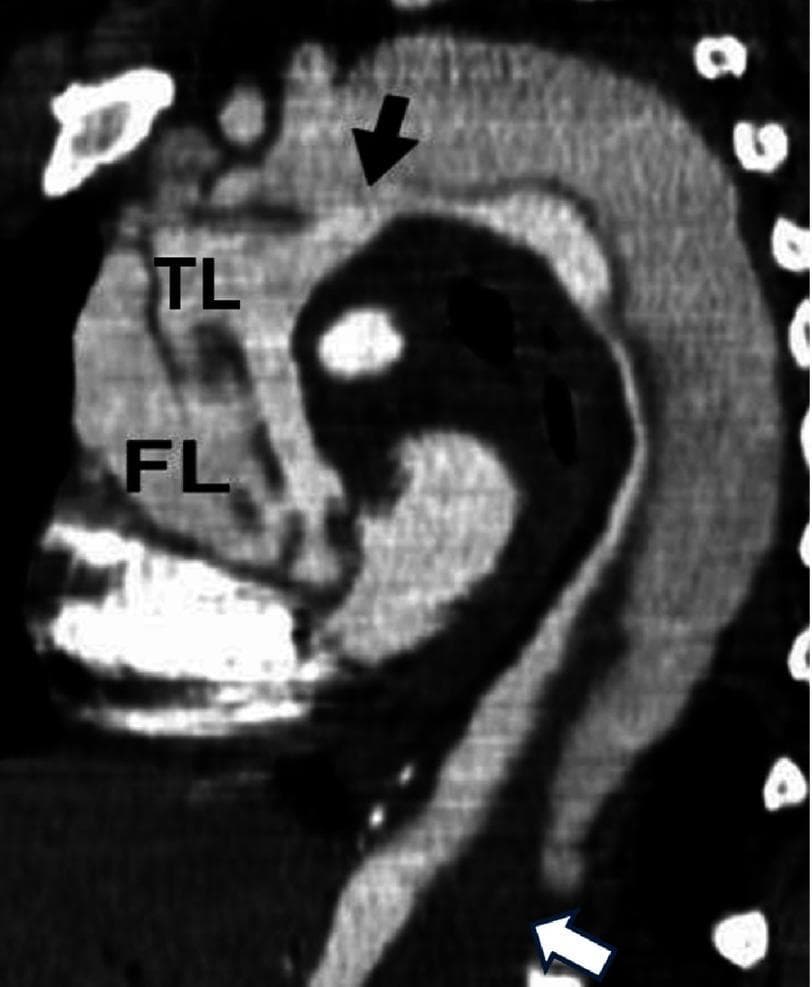 This diagnostic image is a contrast-enhanced CT scan of the thoracic aorta in a sagittal-oblique reconstruction, demonstrating a Stanford Type A Acute Aortic Dissection (AAD). The image reveals a clear intimal flap separating the aorta into a true lumen (TL) and a false lumen (FL). A primary entry tear is identified in the aortic arch, indicated by a black arrow. The dissection exhibits retrograde extension into the ascending aorta and antegrade extension into the descending thoracic aorta. The true lumen (TL) is identified by its smaller size and higher contrast density, whereas the larger false lumen (FL) displays heterogeneous density. A white arrow highlights a critical finding in the distal descending aorta: total thrombosis of the false lumen, characterized by a lack of contrast opacification. This radiological case illustrates the hallmark features used to classify aortic dissections and identify secondary complications like false lumen thrombosis, which is a key prognostic indicator in vascular surgery and emergency medicine.