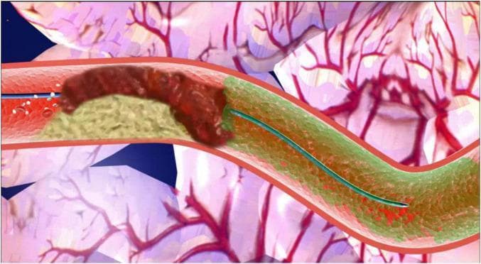 This medical illustration depicts a pathophysiology diagram of an intracoronary artery retrograde thrombolysis (ICART) system during a percutaneous coronary intervention (PCI) for ST-elevation myocardial infarction (STEMI). The primary focus is a longitudinal cross-section of a coronary artery showing total occlusion. A dark reddish-brown, elongated, irregular mass representing a thrombus is visible, situated adjacent to yellowish atherosclerotic plaque material. A thin blue interventional guidewire is shown successfully traversing the occlusion into the distal vessel segment. The distal artery is color-coded green, containing small red patches, indicating the site for retrograde thrombolytic cocktail injection via a microcatheter. The background illustrates the branching coronary vasculature of the heart. This diagram serves as an educational tool to demonstrate the mechanical and pharmacological approach to managing culprit vessel occlusion by delivering thrombolytic agents directly to the distal lumen through a retrograde technique.