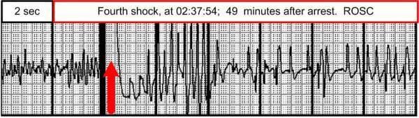 A diagnostic rhythm strip illustrating a critical transition during advanced cardiac life support (ACLS). The image shows a continuous electrocardiography (ECG) tracing on a standard grid, with a primary focus on the transition from a shockable rhythm to Return of Spontaneous Circulation (ROSC). A large red arrow indicates the exact point of defibrillation, identified by a high-amplitude vertical deflection (fourth shock). Prior to the shock, the tracing displays fine ventricular fibrillation (VF), characterized by low-amplitude, chaotic undulations without identifiable P waves or QRS complexes. Immediately following the shock and a brief period of electrical stabilization, the rhythm transitions into an organized sinus rhythm. This post-shock rhythm features relatively narrow QRS complexes and visible P waves, indicating successful electrical cardioversion. The image is annotated with a time scale of 2 seconds per major section and includes a caption stating the event occurred 49 minutes after the initial cardiac arrest. This visual serves as an educational tool for identifying VF, understanding the timing of defibrillatory intervention, and recognizing the ECG manifestations of successful ROSC in emergency medicine.