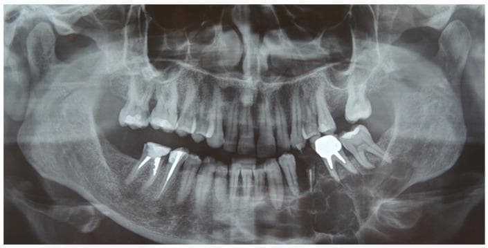 This diagnostic image is a preoperative orthopantomography (panoramic X-ray) of an adult human skull focusing on the dentomaxillofacial complex. The primary pathology is a large, well-defined multilocular radiolucency located in the left mandible. The lesion exhibits a 'soap bubble' or 'honeycomb' appearance characteristic of an ameloblastoma, extending from the left mandibular lateral incisor (tooth 3.2) posteriorly through the molar region (tooth 3.8) and into the ascending ramus. Significant cortical thinning and displacement of the surrounding dental roots are visible. Associated dental findings include several radiopaque endodontic treatments with intraradicular posts in the right mandibular premolars and a large radiopaque crown restoration in the left maxillary molar region. Anatomical landmarks such as the maxillary sinuses, nasal cavity, mandibular condyles, and temporomandibular joints are visible bilaterally. The image serves as a clinical example of odontogenic tumor presentation and is intended for intermediate to advanced oral and maxillofacial pathology education.