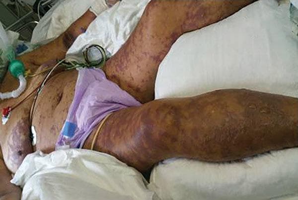 Clinical photograph of a patient in an intensive care unit exhibiting dermatological manifestations of Israeli spotted fever and purpura fulminans. The image shows a diffuse, widespread purpuric rash with a characteristic fern-leaf (arborescent) pattern. The morphology consists of non-blanching reddish-purple spots and larger ecchymotic patches across the abdomen and lower extremities. Progressed lesions on the lower right leg demonstrate the formation of bullae filled with serous fluid, suggesting tissue necrosis. The clinical context is reinforced by life-support equipment, including an endotracheal tube with a green connector for mechanical ventilation, ECG monitoring leads on the chest, and multiple intravenous lines. This visual record illustrates the severe cutaneous evolution of rickettsial diseases, specifically the transition into disseminated intravascular coagulation (DIC) and purpura fulminans in a critical care setting.