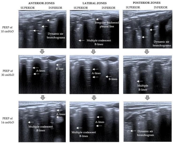 This diagnostic image matrix displays Lung Ultrasound (LUS) frames arranged by anatomical region (Anterior, Lateral, and Posterior zones) and positive end-expiratory pressure (PEEP) levels (10, 30, and 14 cmH2O) to demonstrate recruitment maneuver outcomes. At baseline (PEEP 10 cmH2O), the images show a 'C-pattern' characterized by severe loss of aeration with dynamic air bronchograms in anterior/posterior zones and an irregular thickened pleural line with multiple coalescent B-lines laterally. During recruitment (PEEP 30 cmH2O), there is visible reaeration characterized by a transition to a 'B1-pattern' with horizontal A-lines and well-defined, discrete B-lines. At the final titrated PEEP (14 cmH2O), the 'B2-pattern' is evident, showing some recruitment maintenance via A-lines but recurring multiple coalescent B-lines and persistent dynamic air bronchograms posteriorly. This comparison illustrates the dynamic nature of lung aeration, pleural line morphology, and ultrasound artifacts (A-lines vs. B-lines) in response to mechanical ventilation adjustments in patients with respiratory distress.