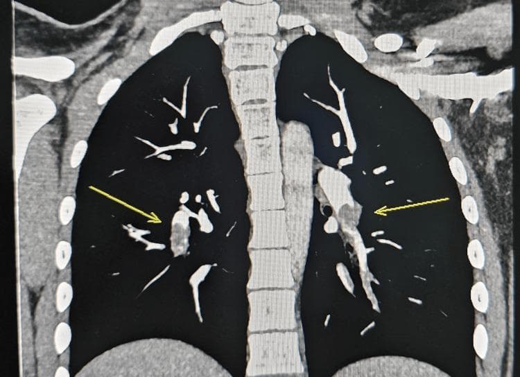 This coronal CT pulmonary angiography (CTPA) scan demonstrates acute pulmonary embolism. The image focuses on the pulmonary vasculature, specifically the arteries supplying the lower lobes of both lungs. Yellow arrows indicate prominent intraluminal filling defects within the left and right pulmonary arteries. These defects appear as hypoattenuating (darker) areas within the bright, contrast-opacified blood vessels, signifying the presence of thrombi that obstruct blood flow. The filling defects result in irregular vessel outlines and a disruption of the continuous contrast enhancement typically seen in healthy arteries. The surrounding lung parenchyma appears clear with normal attenuation, showing no immediate signs of pulmonary infarction, consolidation, or pleural effusion. This diagnostic image serves as a classic illustration of bilateral pulmonary embolism in a clinical setting, emphasizing the importance of vascular contrast imaging for identifying life-threatening thromboembolic events.