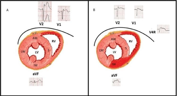 Educational comparison diagram illustrating the progression of myocardial ischemia and associated electrocardiographic (ECG) changes over time (30 vs. 90 minutes). Panel A shows a cross-sectional anatomical diagram of the heart with normal perfusion, labeled with structures including the Anterior Wall (AW), Lateral Wall (LW), Septum (S), Inferior Wall (IW), and Right Ventricle (RV). Corresponding ECG tracings for leads V1, V2, and aVF show baseline morphologies. Panel B demonstrates the progression of a transmural injury, visually indicated by dark red shading in the Inferior Wall (IW) and Right Ventricle (RV). This pathological change is correlated with dynamic ECG findings: leads V1 and V2 show a reduction in ST-elevation amplitude compared to Panel A, while lead aVF now exhibits new ST-segment elevation. Additionally, Panel B includes a right-sided lead V4R showing ST-elevation, diagnostic of right ventricular involvement. The diagram serves to teach the 'wandering' nature of ST-elevation during evolving myocardial infarction, specifically highlighting the shift from early anterior injury vectors to inferior and right ventricular manifestations.