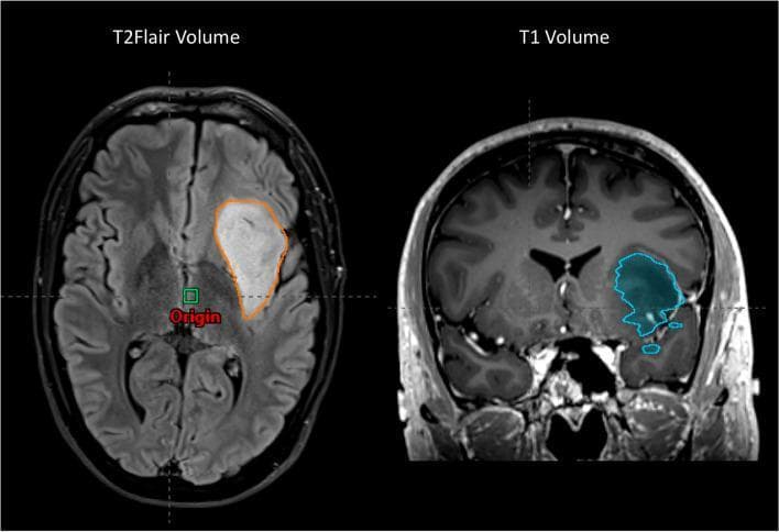 This diagnostic image displays a side-by-side comparison of two MRI sequences—T2 FLAIR (axial view, left) and T1-weighted (coronal view, right)—demonstrating the methodology for tumor volume measurement in a patient with a brain tumor, likely a glioma. In the T2 FLAIR image, the lesion appears hyperintense (bright) and is outlined by an orange contour, highlighting the total extent of the tumor and associated vasogenic edema or infiltrative disease. In the T1-weighted image, the corresponding tumor volume is hypointense (dark) and outlined with a blue contour. Both images feature anatomical orientation markers and an 'Origin' point for spatial normalization, typically used in radiation therapy treatment planning. The visual emphasizes the different signal characteristics of brain pathology across modalities: T2 FLAIR is highly sensitive to tissue water content and edema, while T1 provides superior anatomical detail and shows the core lesion as a low-signal area. This comparison is clinically relevant for neuro-oncology trainees and neuroradiologists for accurate lesion delineation and longitudinal monitoring of tumor response.