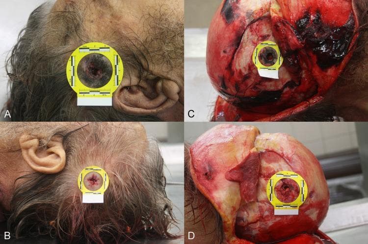 A series of four forensic clinical photographs (A-D) documenting a penetrating gunshot wound to the human head. Panel A displays the entrance wound in the right temporal region, characterized by burned-intruding margins, soot deposition, and a distinct muzzle imprint, indicating a loose contact discharge. Panel B shows the corresponding exit wound in the left temporal region, presenting with irregular, protruding margins and an absence of soot or thermal injury. Panel C illustrates the entrance site following soft tissue dissection; a circular defect in the right temporal bone is visible with significant soot deposition concentrated around the osseous opening. Panel D reveals the exit site on the left temporal bone, showing characteristic external beveling of the outer table, where the defect is wider on the exterior than the interior. Each panel includes a yellow forensic scale for size reference. This series demonstrates the classic diagnostic features used in forensic pathology to differentiate between entry and exit ballistic trauma, as well as to determine range of fire.