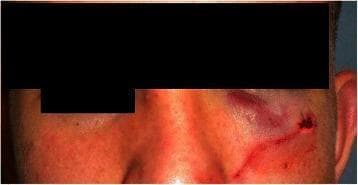 This clinical photograph displays a frontal view of a patient's midface, focusing on the left periorbital and suborbital regions. The image demonstrates significant moderate edema (swelling) and extensive ecchymosis (bruising) localized to the left suborbital area and the lower eyelid, characterized by deep purple and reddish discoloration. A linear incision site is visible at the lateral aspect of the infraorbital rim, secured with medical skin sutures, indicating recent surgical intervention. The surrounding facial skin shows generalized erythema, potentially reflecting inflammatory changes or trauma-induced irritation. The contralateral (right) side of the face appears unremarkable, providing a baseline for assessing the unilateral swelling and facial asymmetry. Clinically, this presentation is consistent with post-traumatic or post-surgical changes following a maxillofacial injury or orbital floor exploration. The visual features highlight key signs of soft tissue trauma and the immediate postoperative state of the orbital frame.