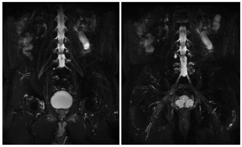 Diagnostic Image: This figure presents two coronal Maximum Intensity Projection (MIP) reconstructions from a 3D T2-weighted MRI sequence (likely a 3D CUBE or similar high-resolution neurography sequence) focusing on the lumbosacral plexus. The central vertical structure is the lumbar spinal column, where the thecal sac and exiting nerve roots exhibit high signal intensity against the suppressed background. The lumbar (L4, L5) and sacral (S1-S4) nerve roots are visible as thin, linear, branching structures extending laterally and inferiorly from the spine to form the plexus. The urinary bladder appears as a prominent, hyperintense spherical structure in the lower pelvic region. The images demonstrate normal anatomical morphology, with the nerve roots showing regular caliber, symmetry, and uniform signal intensity. There is no evidence of pathological contrast enhancement, hypertrophy, or diffuse swelling in this specific reconstruction. This imaging modality is essential in neurology and radiology for evaluating inflammatory or hereditary neuropathies and plexopathies by suppressing background fat and muscle to highlight neural architecture.