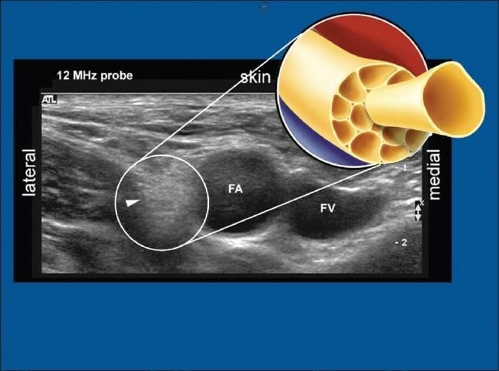 This composite educational image features a diagnostic ultrasound scan paired with an anatomical diagram, focusing on the femoral neurovascular bundle. The ultrasound, captured with a 12 MHz high-frequency linear probe, shows the femoral nerve in a transverse cross-section. The nerve is characterized as a distinct hyperechoic structure (brighter than surrounding tissue) located lateral to the pulsatile femoral artery (FA) and the compressible femoral vein (FV). An arrowhead points to the nerve, which exhibits a characteristic 'honeycomb' echotexture. A circular call-out diagram provides a histological illustration of the nerve's internal morphology, detailing numerous nerve fascicles bundled together by a dense perineurium and surrounded by epineurium. This visual comparison highlights the correlation between peripheral nerve microanatomy (fascicular arrangement) and its sonographic appearance. This material is essential for regional anesthesia training and ultrasound-guided femoral nerve block procedures within the fields of anesthesiology, radiology, and emergency medicine.