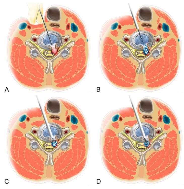 Anatomical diagram in axial cross-section illustrating the four key stages of a Percutaneous Endoscopic Cervical Discectomy (PECD). Stage A: Demonstrates the anterior percutaneous approach, showing manual displacement of the trachea medially and the carotid sheath laterally to establish a safe entry corridor for the spinal needle. Stage B: Illustrates sequential dilation over the initial guide needle, creating a path through the annulus fibrosus toward the herniated disc material. Stage C: Depicts the use of a side-firing laser or radiofrequency dissector to release the annular anchorage and fragment the herniated disc tissue while maintaining visualization. Stage D: Shows the selective removal of the herniated fragment using endoscopic forceps, achieving decompression of the neural structures while preserving the central nucleus pulposus. The illustrations highlight the relationship between the surgical instruments and key neck anatomy, including the vertebral body, spinal cord, nerve roots, and surrounding musculature.