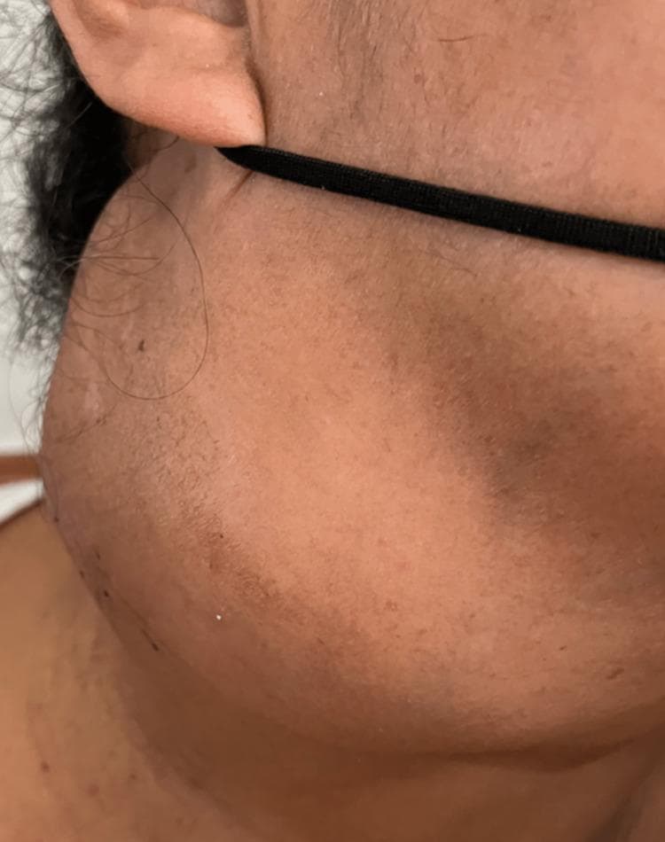 This clinical photograph shows a large, prominent mass on the right lateral aspect of the neck in a human patient. The swelling is located in the cervical region, extending inferiorly from the level of the earlobe toward the supraclavicular area, measuring approximately 10x10 cm. The mass presents with a smooth, dome-shaped contour and uniform consistency, significantly distorting the natural anatomy of the neck. Notably, the overlying skin appears intact and normal in color, with no visible signs of acute inflammation such as erythema, edema, ulceration, or draining fistulae. The absence of inflammatory signs and the progressive growth of the lesion are key clinical features. This image serves as an educational example of significant cervical lymphadenopathy or a soft tissue neck mass, relevant for differential diagnosis in oncology, infectious disease (such as extrapulmonary tuberculosis), and granulomatous conditions (like sarcoidosis).