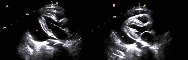 This diagnostic image consists of two side-by-side echocardiogram frames (labeled A and B) in a parasternal long-axis view, demonstrating the pathognomonic signs of cardiac tamponade. The images show a large, circumferential pericardial effusion, visualized as a prominent hypoechoic (black) space surrounding the myocardium, indicated by red asterisks. Panel A illustrates diastolic right ventricular collapse, where the anterior wall of the right ventricle is compressed by the high-pressure fluid. Panel B, compared to Panel A, shows a shift in the heart's position and the relative distribution of the fluid within the pericardial sac. This dynamic shifting of the heart within the large volume of fluid is known as 'swinging heart' physiology. This phenomenon is a critical echocardiographic finding often associated with electrical alternans on an ECG and clinical tamponade, indicating a medical emergency. The visualization is essential for medical students and clinicians to recognize hemodynamic compromise requiring urgent pericardiocentesis.