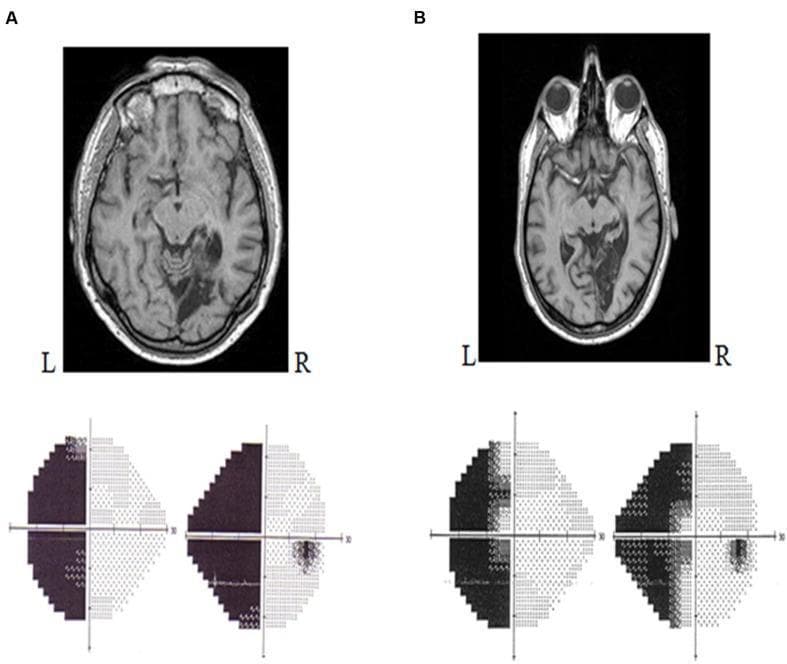This composite educational graphic compares neuroimaging and corresponding visual field deficits in two clinical cases (A and B). The upper sections show axial T1-weighted MRI scans of the brain. In both cases, there is a large, hypointense (dark) lesion in the right posterior cerebrum, primarily involving the occipital lobe, consistent with a right-sided stroke or infarction in the territory of the posterior cerebral artery (PCA). The lower sections display Humphrey automated perimetry (SITA FAST 24-2) grayscale plots for both eyes. Case A illustrates a complete left homonymous hemianopia, characterized by dense, uniform darkening of the entire left visual field in both eyes, indicating total loss of peripheral and central vision on that side. Case B illustrates a left homonymous hemianopia with macular sparing. While the left hemi-field is largely darkened, there is a distinct preservation of visual sensitivity at the central fixation point (macula), a common clinical finding in PCA infarcts where the occipital pole receives collateral blood supply. This material is used to demonstrate the clinicopathological correlation between cerebral cortex lesions and specific patterns of visual field loss.