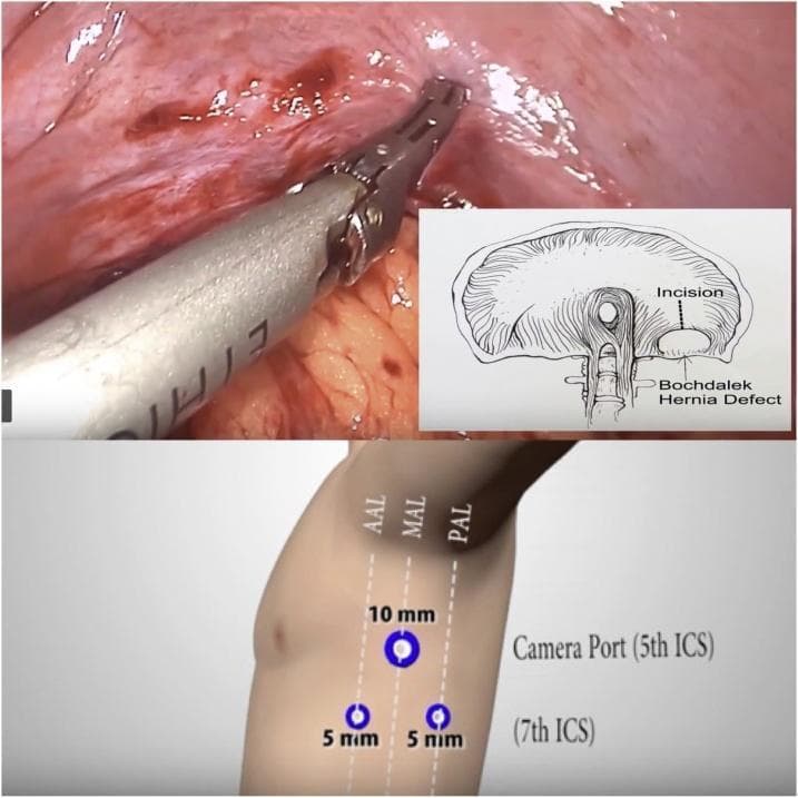A composite medical illustration and intraoperative image detailing the surgical management of a Bochdalek hernia. The upper panel displays a laparoscopy frame showing the diaphragm with a 'pendulum-shaped incision' made to facilitate the reduction of herniated viscera. A surgical instrument is seen manipulating the vascularized, pink diaphragmatic tissue. An inset anatomical diagram clarifies the orientation, showing the relationship between the central tendon, the esophageal hiatus, the Bochdalek hernia defect, and the relief incision. The lower panel is a clinical diagram of thoracoscopic port placement on the left lateral chest wall. It illustrates the positioning of a 10 mm camera port at the 5th intercostal space (ICS) along the midaxillary line (MAL), flanked by two 5 mm working ports at the 7th ICS. Key anatomical landmarks are labeled, including the anterior axillary line (AAL), midaxillary line (MAL), and posterior axillary line (PAL), providing a guide for surgical access in thoracic surgery.