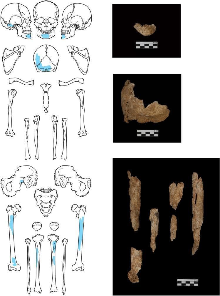 This composite educational image provides an anatomical and forensic overview of excavated human skeletal remains. On the left, an anatomical diagram of a complete human skeleton is presented with specific regions highlighted in blue to indicate recovered fragments. These include sections of the cranium, the mandible, cervical and thoracic vertebrae, parts of the pelvis, and mid-shaft segments of the femur and tibia. On the right, three clinical photographs display the actual archaeological bone fragments against a black background, each accompanied by a 5 cm scale bar. The top photograph shows a partial mandible fragment. The middle photograph depicts a larger, irregular portion of the cranium. The bottom photograph shows multiple longitudinal fragments of cortical bone, consistent with the diaphysis of long bones like the femur or tibia. The bones exhibit a weathered, porous texture and a beige-to-tan coloration indicative of taphonomic changes and mineralization. This visual is designed for physical anthropology and forensic osteology, illustrating the mapping of fragmented remains to the anatomical whole.