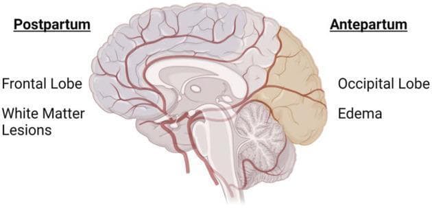 A medical anatomical diagram illustrating the differential cerebral involvement in preeclampsia during the antepartum and postpartum periods. The image features a sagittal view of the human brain with a red cerebral vasculature overlay, highlighting two distinct regions of clinical significance. The posterior region (occipital and parietal lobes) is shaded in tan and labeled 'Antepartum,' indicating the common occurrence of cerebral edema during pregnancy. The anterior region (frontal lobe) is labeled 'Postpartum,' specifically associated with the development of white matter lesions. This diagram serves as a visual explanation of the regional pathophysiology and neuroimaging findings associated with (pre)eclampsia, emphasizing how the timing relative to delivery (pregnancy vs. postpartum) correlates with specific anatomical localizations of brain injury. Key educational concepts include the clinical manifestations of hypertensive disorders of pregnancy, blood-brain barrier disruption, and regional vascular susceptibility in the brain.