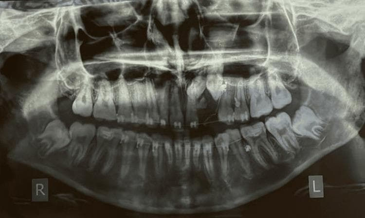 An orthopantomograph (OPG) or panoramic radiograph of a human dentition showing significant anomalies in the upper left anterior quadrant. The image demonstrates a cluster of multiple, small, radio-opaque tooth-like structures (denticles) in the region of the maxillary left lateral incisor and canine, characteristic of a compound odontoma. This calcified mass is associated with the failure of eruption and subsequent impaction of the permanent maxillary left lateral incisor (22) and canine (23), which are visible superior to the odontoma. Overretained deciduous teeth (62 and 63) are present in the corresponding arch segment. Fixed orthodontic appliances, including brackets and archwires, are visible on the maxillary and mandibular arches, indicating active orthodontic management. Other notable features include horizontally impacted mandibular third molars and evidence of orthodontic traction. This diagnostic image is significant for demonstrating the role of odontogenic tumors in tooth impaction and the utility of panoramic imaging in orthodontic treatment planning.