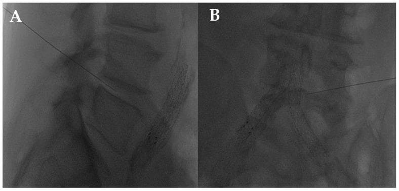 This diagnostic fluoroscopic image set illustrates a lumbar intersomatic disc puncture procedure using a 22G needle, commonly performed for intradiscal injections such as oxygen-ozone (O2-O3) therapy. Image A presents a lateral view of the lumbar spine, demonstrating the needle's trajectory from a posterior-lateral entry point. The needle tip is clearly visualized penetrating the intervertebral disc space between two lumbar vertebrae, positioned centrally within the disc. Image B shows the frontal (anteroposterior) view of the same procedure, highlighting the needle traversing toward the radiolucent gap representing the disc space. The stacked vertebral bodies and their respective endplates serve as critical anatomical landmarks for verifying correct needle placement. Of note, radiopaque vascular stents are visible in the foreground, indicating the patient's comorbidities. This visual serves as an educational guide for image-guided spinal interventions, focusing on the transforaminal or lateral approach to the nucleus pulposus for treating chronic low back pain or disc herniation.