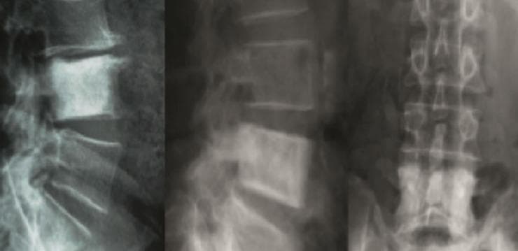 This diagnostic imaging composite displays anteroposterior (AP) and lateral x-ray radiographs of the lumbar spine. The primary finding is a classic 'ivory vertebra' involving the L4 level. In both views, the L4 vertebral body exhibits diffuse, uniform sclerosis, appearing significantly more radiopaque (whiter) than the adjacent levels. The lateral views (left and center panels) demonstrate the preservation of the vertebral height and cortical margins despite the intense internal hyperdensity. The AP view (right panel) shows the midline spinous processes, pedicles, and transverse processes, with L4 standing out as a densely mineralized rectangular structure. Clinically, this radiographic sign is characteristic of osteoblastic metastases, most commonly from prostate cancer, though it can also be seen in Paget's disease or lymphoma. The image serves as an educational example of sclerotic bone lesions in the axial skeleton.