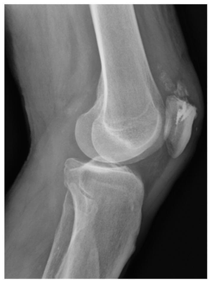 This lateral view X-ray of the knee demonstrates the anatomical alignment of the distal femur, proximal tibia, and patella. The primary clinical focus is on the patellofemoral compartment, where evidence of prior orthopedic surgical intervention for quadriceps tendon reconstruction is visible. Four radiopaque suture anchors (TWINFIX) are identifiable as dense, metallic-density markers embedded within the superior aspect of the patellar bone. Faint, linear radiopacities extending from these anchors represent high-strength non-absorbable suture material used to secure the quadriceps tendon. The joint space between the femoral condyles and the tibial plateau appears preserved, and the tibial tuberosity is clearly visible on the anterior proximal tibia. This image serves as a clinical example of postoperative hardware placement for extensor mechanism repair in the knee, highlighting the use of suture anchors for soft-tissue-to-bone fixation.