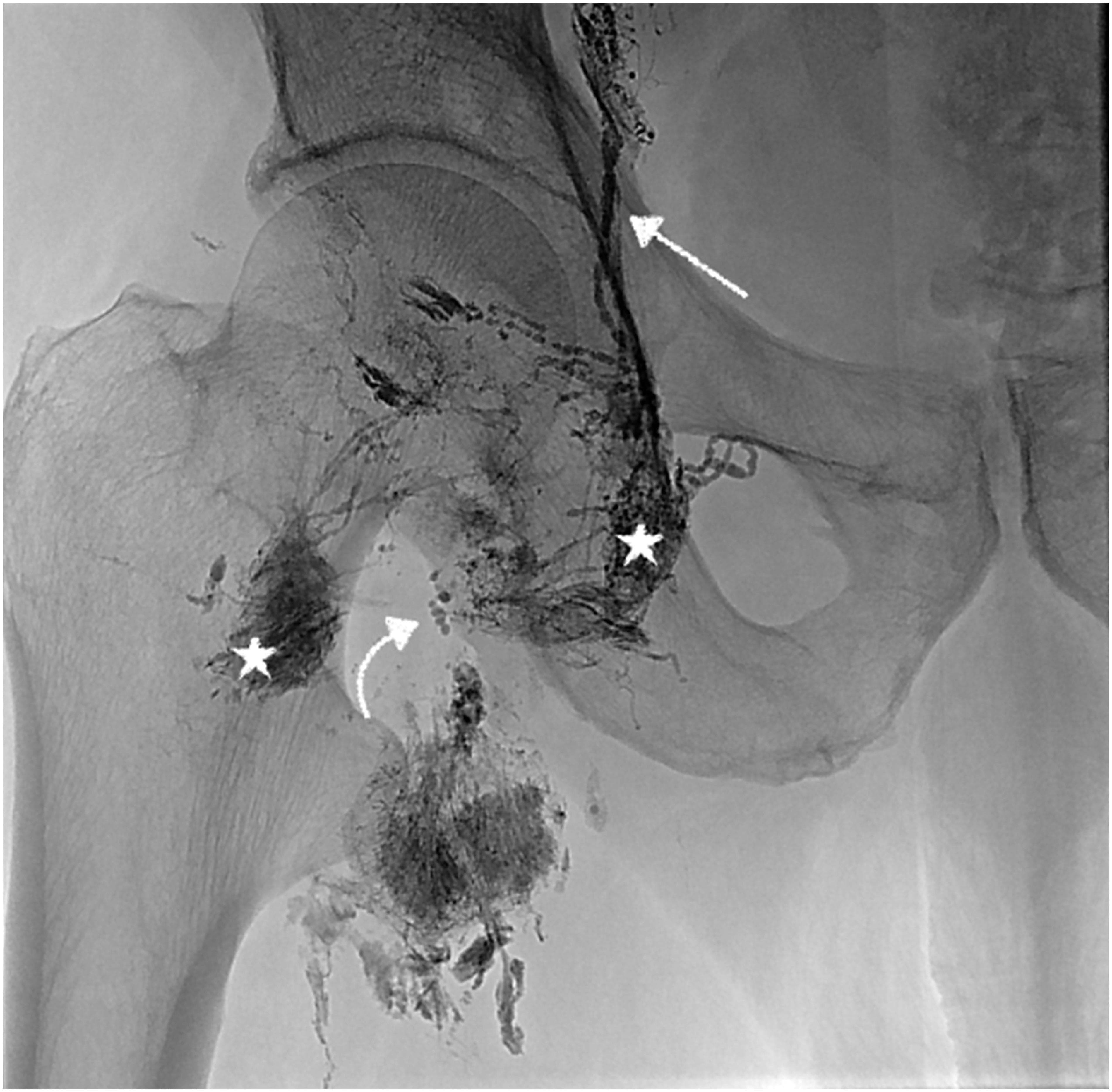 This diagnostic image is an intranodal lymphangiogram of the right groin region, demonstrating contrast-enhanced lymphatic anatomy and pathology. The image reveals multiple inguinal lymph nodes injected with contrast material (marked with stars), appearing as dense, opaque aggregates. Connecting these nodes are normal lymphatic vessels, visualized as thin, well-defined, linear branching structures (indicated by a straight arrow). A significant finding is the presence of lymphatic extravasation, characterized by an amorphous, cloud-like distribution of contrast material leaking from a medially located lymph node (indicated by a curved arrow). This extravasation represents a lymphatic leak or lymphorrhea, contrasting with the discrete margins of the healthy vessels. The imaging provides essential clinical context for identifying specific leakage sites in patients with post-surgical wound complications, such as those following vascular interventions, and serves as a roadmap for subsequent interventional procedures like N-butyl cyanoacrylate (NBCA) glue embolization.