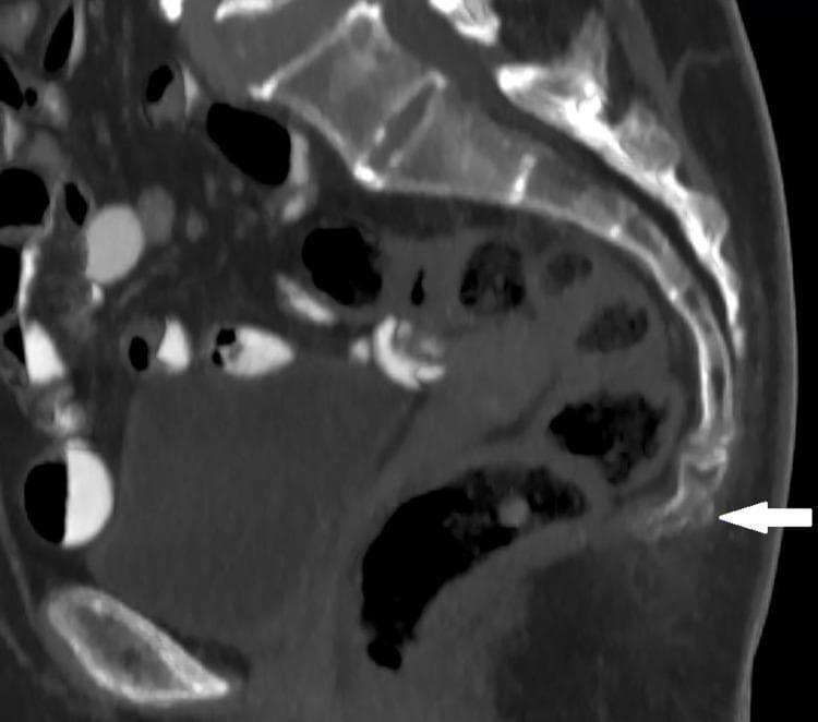 This diagnostic image is a midline sagittal computerized tomography (CT) scan of the lower spine and pelvic region, focusing on the sacrococcygeal anatomy. The image demonstrates the curvature of the sacrum and the articulated segments of the coccyx. A prominent white arrow indicates a coccygeal spicule, which is a small, pointed, bony outgrowth with high radiodensity located at the distal tip of the terminal coccygeal segment. Surrounding soft tissue structures, including the rectum and pelvic floor musculature, are visible anterior to the bony column with lower attenuation values. This CT finding is clinically relevant in the evaluation of coccydynia, as a spicule can cause irritation of the overlying skin or subcutaneous tissues during sitting. The image serves as a teaching tool for recognizing morphological variations in coccygeal anatomy and identifying specific causes of idiopathic tailbone pain.