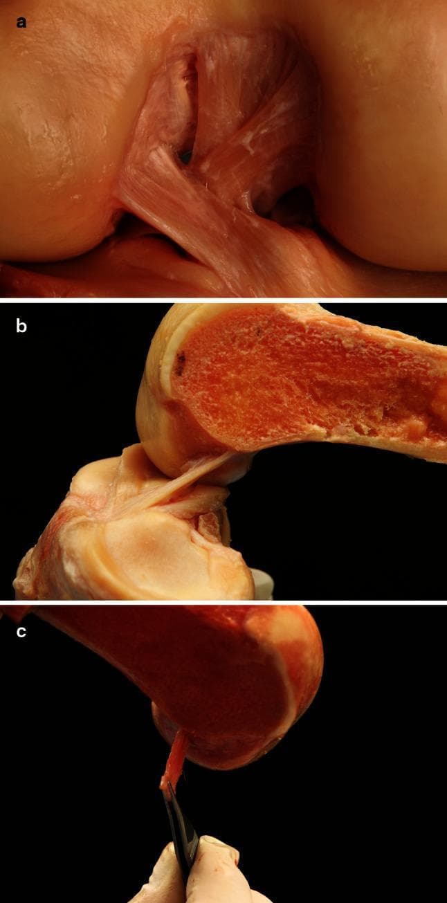 This composite of clinical anatomical photographs (panels a-c) displays the macrostructure of the anterior cruciate ligament (ACL) in a dissected human knee joint. Panel 'a' provides an anterior view of the knee with synovial tissue removed, highlighting the ACL's morphology as a flat, ribbon-like band rather than a cylindrical cord. The ligament demonstrates a cohesive, broad fiber arrangement spanning from the femoral condyle to the tibial plateau without distinct separation into anteromedial or posterolateral bundles. Panel 'b' shows a sagittal cross-section of the femur, illustrating the ligament's direct attachment to the posterior femoral cortex. The fibers are seen inserting into the bone at an acute angle, maintaining continuity with the osseous surface. Panel 'c' utilizes surgical forceps to further demonstrate the thin, wide 'ribbon' profile of the ACL at its midsubstance. This content is highly relevant for orthopedic anatomy and surgical planning, specifically regarding ACL reconstruction techniques that aim to replicate the native flat anatomy of the ligament and its precise femoral insertion footprint.