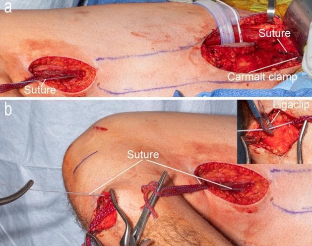 This clinical photograph consists of two panels (a and b) illustrating a surgical technique for musculotendinous unit (MTU) length measurement during a gracilis muscle harvest. Panel (a) shows a proximal thigh incision where a white #2 fiber wire suture is secured at the gracilis origin on the pubic ramus using a Carmalt clamp. The suture is threaded subcutaneously toward a distal thigh incision. Panel (b) depicts the suture continuing from the distal thigh incision through to a third incision at the pes anserine on the medial proximal tibia. An inset in panel (b) shows the use of a titanium Ligaclip to mark the specific length of the MTU at the level of the tibial tubercle. The surgical field includes visible longitudinal incisions, anatomical blue skin markings for surgical planning, umbilical tape for tendon manipulation, and standard retractors. This procedure is critical for intraoperative muscle force measurements and functional transfers, ensuring precise length-tension relationships are maintained.