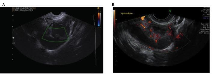 Two-panel transvaginal sonography (TVS) image demonstrating the features of acute salpingitis. Panel A displays a color Doppler ultrasound of a dilated fallopian tube, appearing as a pear-shaped, unilocular adnexal mass. The mass contains low-level echogenic fluid and is characterized by thickened walls (exceeding 5 mm) and multiple incomplete septae extending into the lumen. Panel B shows a power Doppler ultrasound of the same structure, highlighting significant hypervascularity concentrated within the incomplete septae and the thickened tubal wall. These internal projections and the increased vascular signal are classic sonographic indicators of an active inflammatory process, such as acute pelvic inflammatory disease (PID). The morphology of the tube with internal protrusions may also suggest a 'cogwheel sign' when viewed in transverse section, distinguishing acute salpingitis from simple hydrosalpinx.