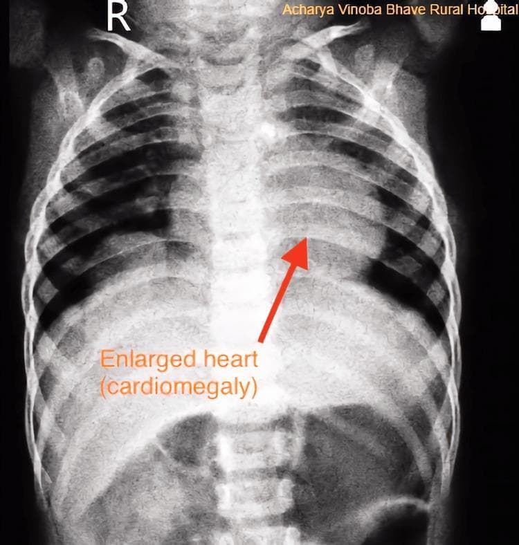 This diagnostic image is an anterior-posterior (AP) chest X-ray of a pediatric patient, showing significant cardiomegaly. The cardiac silhouette is markedly enlarged, with the cardiothoracic ratio exceeding 0.5. The enlargement is particularly prominent in the region of the left ventricle and left atrium, which causes displacement and relative crowding of the adjacent pulmonary structures. An orange arrow and text label specifically point to the left cardiac border to highlight the 'Enlarged heart (cardiomegaly)'. The bony structures, including the ribs and spine, are visible, and the diaphragm appears somewhat flattened due to the increased heart size. The imaging demonstrates the typical radiological presentation of volume overload or congenital cardiac anomalies, such as a patent ductus arteriosus (PDA) or persistent left superior vena cava, which can lead to progressive chamber dilation.