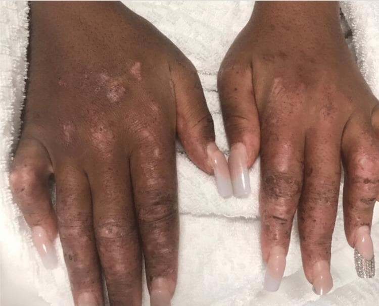 This clinical photograph displays the dorsal surface of the hands and fingers in a patient with a known history of systemic autoimmune disease, including systemic lupus erythematosus (SLE) and scleroderma. The image demonstrates significant cutaneous manifestations characterized by diffuse dyspigmentation. Key features include multiple hypopigmented (leukoderma-like) macules and patches interspersed with areas of hyperpigmentation and scattered dark macules, particularly prominent over the metacarpophalangeal and interphalangeal joints. The skin texture appears thickened and indurated, consistent with sclerodactyly, with visible xerosis and fine scaling. There is evidence of mild soft tissue swelling of the digits, resulting in a slightly tapered or 'sausage-digit' appearance. These findings are clinically significant as they illustrate the overlap features of connective tissue diseases, showing both the pigmentary changes often seen in chronic cutaneous lupus and the structural skin tightening characteristic of systemic sclerosis. The nails feature artificial extensions, which limit the evaluation of the underlying nail beds for splinter hemorrhages or telangiectasia.