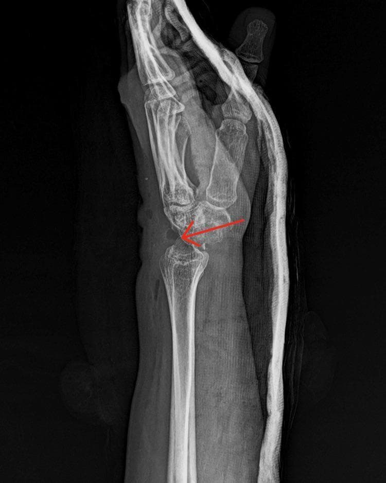 This lateral view X-ray of the wrist demonstrates post-operative findings following a proximal row carpectomy (PRC). The imaging reveals the surgical absence of the proximal carpal row (scaphoid, lunate, and triquetrum). The head of the capitate is shown articulating directly with the lunate fossa of the distal radius, a hallmark of this motion-preserving procedure used to treat advanced Kienbock's disease or SLAC/SNAC wrist. A red arrow highlights the surgical site and the new radiocapitate articulation. Encasing the forearm and wrist is a radiopaque cast or splint, which creates a hazy silhouette around the anatomical structures and confirms the immediate post-operative phase. The distal radius and distal carpal row (trapezium, trapezoid, capitate, and hamate) remain visible, though their spatial relationship is altered to accommodate the shortened carpus. This diagnostic image is significant for orthopedic training in identifying salvaging procedures for chronic wrist instability and carpal collapse.