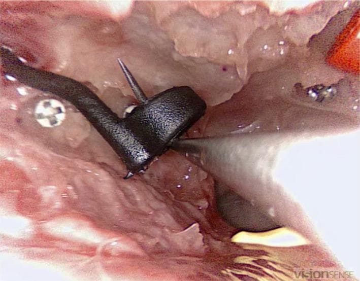 This endoscopic clinical photograph depicts an endonasal surgical procedure within a sinus cavity, likely the maxillary or sphenoid sinus. The visual field shows the moist, erythematous, and textured mucosal lining of the nasal passage. A specialized surgical instrument, appearing as a matte black fine wound retractor with a hooked tip, is actively manipulating a small, ring-shaped foreign object (EDGES™ Zig Aligna™). Several metallic, cross-headed surgical screws or navigation markers are embedded into the surrounding bony landmarks to assist with intraoperative navigation. The image demonstrates a precision task in endoscopic sinus surgery, focusing on the retrieval of small objects from deep paranasal structures. The educational focus highlights surgical dexterity, the use of specialized instrumentation in confined anatomical spaces, and the integration of surgical navigation systems in Otolaryngology (ENT).