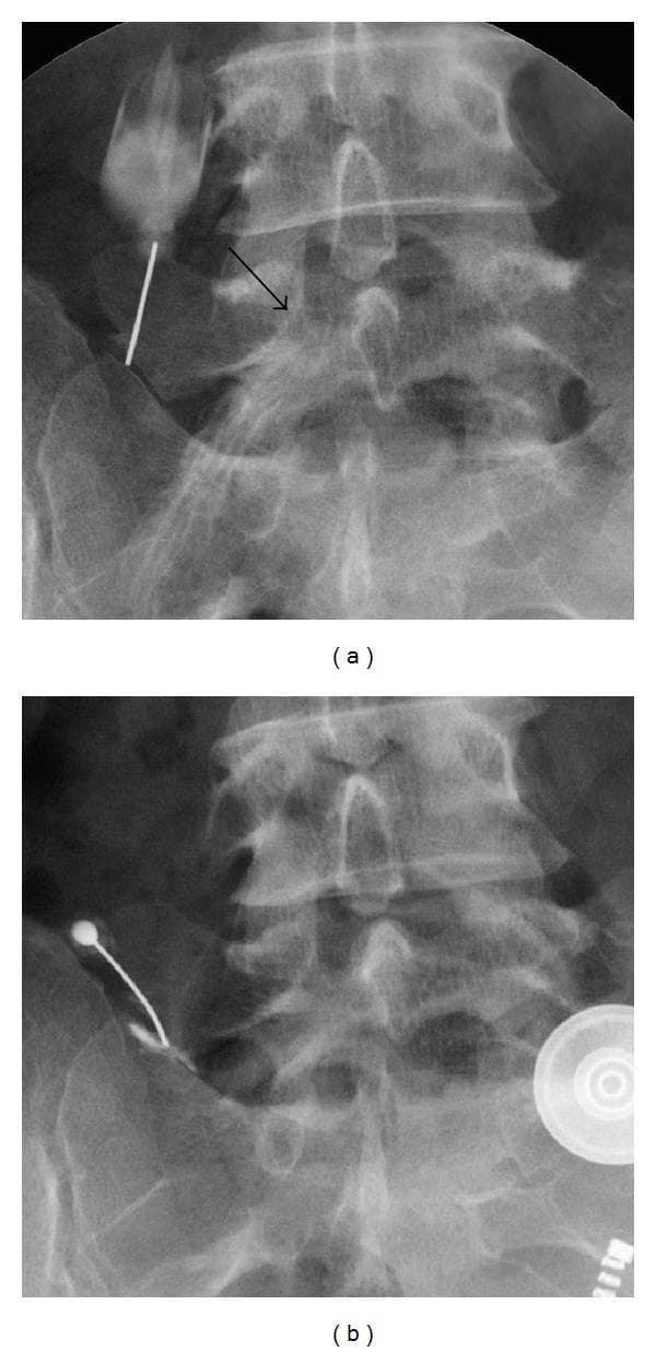 Two anteroposterior fluoroscopic radiographs (a and b) of the lumbar spine, focusing on the L5-S1 junction. Image (a) depicts a selective radiculograph of the left L5 nerve root. A radiopaque needle is positioned near the left transverse process. Contrast medium delineates the L5 nerve root pathway, with a black arrow indicating nerve root impingement at the lateral recess. The image demonstrates the diagnostic approach to sciatica in the context of possible Bertolotti's syndrome. Image (b) shows a local diagnostic injection into the pseudoarthrosis or gap between the enlarged left L5 transverse process and the sacral ala. A radiopaque needle and accumulated contrast are visible at the articulation site. The clinical focus is the identification of the source of low back pain versus radicular pain through targeted infiltration. These images are intended for intermediate to advanced medical learners studying spinal pathology, interventional pain management, and anatomical variations of the lumbosacral junction.