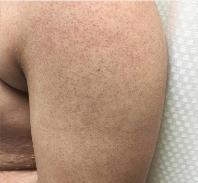 This clinical photograph displays a close-up view of the skin, likely on the extensor surface of an arm or leg, demonstrating classic features of Keratosis pilaris. The primary findings consist of numerous, densely distributed, pinpoint erythematous papules that are distinctly follicular in origin. These conical, slightly raised lesions give the skin a characteristic 'goose-flesh' or sandpaper-like rough texture. The background skin exhibits subtle reddish hyperpigmentation and erythema concentrated around the hair follicles. No secondary changes such as scaling, blistering, or pustules are present. This image serves as a high-quality educational example of a common benign dermatological condition involving keratinous plugging of the hair follicles, typically seen in the pediatric and adolescent populations on the proximal extremities and trunk.