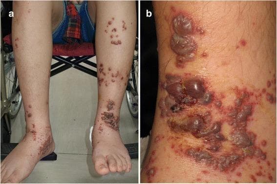 Clinical photograph of the lower extremities of a pediatric patient presenting with severe cutaneous manifestations of leukocytoclastic vasculitis, consistent with Henoch-Schönlein purpura (HSP). Panel (a) provides a bilateral view of both legs, showing extensive, palpable purpuric macules and papules distributed from the dorsal feet to the mid-shins. Interspersed among the purpura are multiple elevated vesicles and bullae. Panel (b) shows a close-up of the left ankle and dorsal foot, highlighting the progression of lesions. Visible features include large, tense hemorrhagic bullae (ranging from 2-20 mm), several of which have ruptured to form dark, adherent crusts and superficial erosions. The surrounding skin exhibits confluent erythematous and violaceous purpuric patches. These findings illustrate a rare, bullous variant of IgA vasculitis, demonstrating the characteristic progression from maculopapular purpura to hemorrhagic vesiculobullous lesions on gravity-dependent areas.