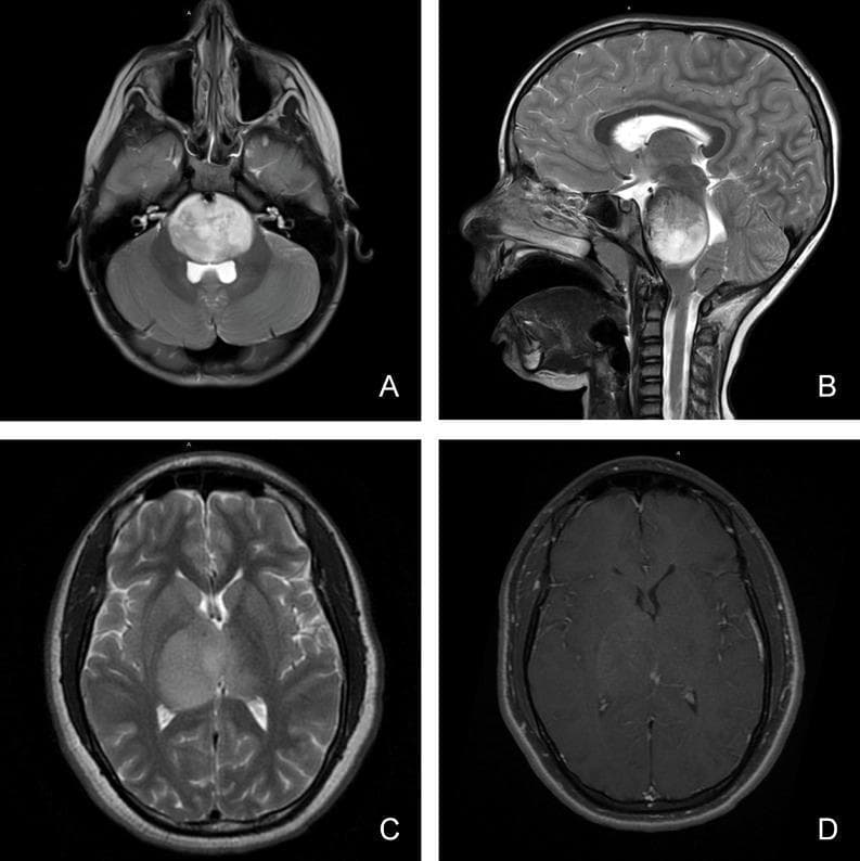 This composite of four magnetic resonance imaging (MRI) scans illustrates the diagnostic features of pediatric diffuse midline glioma in different anatomical locations. Panels A (axial) and B (sagittal) display T2-weighted sequences showing a large, hyperintense, and expansile mass involving the brainstem (pons), characteristic of a diffuse intrinsic pontine glioma (DIPG). The lesion demonstrates an infiltrative growth pattern, causing significant local mass effect and compression of adjacent structures. Panels C and D focus on a thalamic presentation. Panel C is an axial T2-weighted image showing a homogenous, hyperintense lesion within the right thalamus with poorly defined margins extending into the surrounding white matter tracts. Panel D shows the corresponding axial T1-weighted post-gadolinium sequence, revealing minimal to heterogeneous contrast enhancement within the thalamic mass. These images highlight key radiological hallmarks including the tumor's midline location, infiltrative nature, perilesional edema, and variable vascular permeability as indicated by enhancement patterns, which are critical for the clinical classification of these high-grade pediatric gliomas.