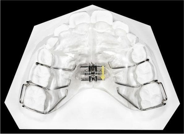 This clinical photograph displays an occlusal view of a Maxillary Removable Schwartz Appliance mounted on a dental cast. The orthodontic device features a transparent, horseshoe-shaped acrylic palatal body designed for a close fit against the palatal and gingival tissues. A stainless steel expansion screw is centrally embedded at the midline, intended to sit over the median palatal suture; a yellow arrow indicates the direction for activation of the screw mechanism. For retention, the appliance utilizes various metal wire components: Adams clasps are located posteriorly to engage the first permanent molars, while button clasps are positioned anteriorly in the interproximal spaces of the deciduous molars. This appliance is primarily used in pediatric orthodontics for slow transverse expansion of the maxillary arch to resolve crowding or correct crossbites.