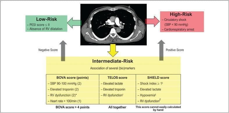 This composite educational graphic combines diagnostic imaging and a clinical decision-making algorithm for the risk stratification of acute pulmonary embolism (PE). At the center is an axial view of a Contrast-Enhanced Computed Tomography (CT) scan of the chest, specifically a CT pulmonary angiogram (CTPA). The image displays the thoracic cage, lungs, mediastinum, and cardiac structures, notably demonstrating filling defects in the pulmonary arteries consistent with PE. The surrounding flowchart categorizes PE severity into three tiers: Low-Risk, Intermediate-Risk, and High-Risk. Low-Risk is defined by a Pulmonary Embolism Severity Index (PESI) score ≤ II and absence of Right Ventricular (RV) dilatation. High-Risk is identified by hemodynamic instability (circulatory shock, SBP < 90 mmHg, or cardiorespiratory arrest). The Intermediate-Risk section utilizes integrated biomarkers and scoring systems, including the BOVA score (focusing on SBP, troponin, RV dysfunction, and heart rate), the TELOS score (lactate, troponin, and RV dysfunction), and the SHIELD score (shock index, lactate, hypoxemia, and RV dysfunction). This educational visual illustrates how imaging findings of RV strain and clinical scores guide patient prognosis and triage.