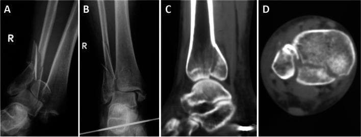 This composite diagnostic image illustrates an 'Open Logsplitter' injury of the right ankle, characterized by a severe fracture-dislocation with proximal talar displacement into the distal tibiofibular syndesmosis. Panel A (anteroposterior X-ray) shows the initial injury with significant talar displacement and a comminuted fibular fracture above the syndesmotic level. Panel B shows the ankle after closed reduction, with the talus repositioned within the mortise, although fracture lines in the fibula and distal tibia remain evident. Panels C and D provide computed tomography (CT) detail. The coronal CT reconstruction (C) demonstrates the longitudinal split and articular surface disruption of the distal tibia. The axial CT scan (D) confirms a posterior pilon fracture, showing a posterior compression fragment and cortical irregularity of the distal tibia along with widening of the syndesmotic space. The case highlights a complex high-energy trauma involving syndesmotic disruption and articular impaction, requiring careful radiological assessment for surgical planning.