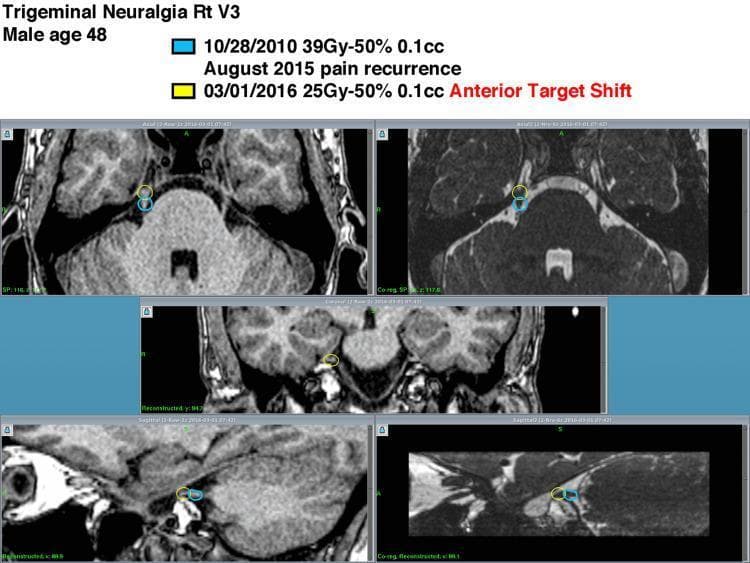 Diagnostic imaging montage featuring multi-planar MRI scans (axial, coronal, and sagittal views) for dosimetric planning of repeat Gamma Knife Radiosurgery (GKRS) in a 48-year-old male with recurrent right trigeminal neuralgia (V3 distribution). The images illustrate the spatial relationship between two separate treatment targets along the cisternal segment of the right trigeminal nerve. A blue marker indicates the initial target from October 2010 (39 Gy at the 50% isodose line, 0.1 cc volume). A yellow marker identifies the second target from March 2016 (25 Gy at the 50% isodose line, 0.1 cc volume), following pain recurrence in August 2015. The second procedure demonstrates an intentional 'Anterior Target Shift' relative to the original treatment site to avoid excessive cumulative radiation dose to the same nerve segment while addressing the recurrence. The MRI sequences provide high-resolution visualization of the brainstem, cerebellopontine angle, and nerve root entry zone, essential for precise stereotactic localization in neurosurgical oncology and pain management.