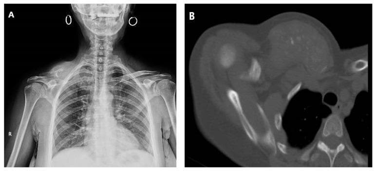 This composite figure displays diagnostic imaging of a 60-year-old female with extensive locoregional metastasis to the right clavicle from cervix adenocarcinoma. Image (A) is a posterior-anterior (PA) chest radiograph showing significant structural disruption and increased radiopacity of the right clavicle compared to the normal appearance of the left. There is associated soft tissue swelling and apical lung density on the right side. Image (B) is an axial CT scan (computed tomography) in a bone window, revealing a large, heterogeneous, and infiltrative soft tissue mass centered on the right clavicle. The image demonstrates advanced osteolysis (bone destruction) and cortical erosion of the clavicle, with tumor extension into the surrounding pectoral and supraclavicular musculature. These findings illustrate the aggressive nature of secondary bone tumors (metastatic disease) in the thoracic girdle, emphasizing the importance of multi-modal imaging in staging and evaluating the extent of musculoskeletal involvement in advanced malignancies.